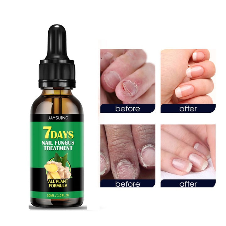 Tratament pentru ciuperca unghiilor