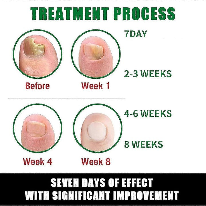 Tratament pentru ciuperca unghiilor